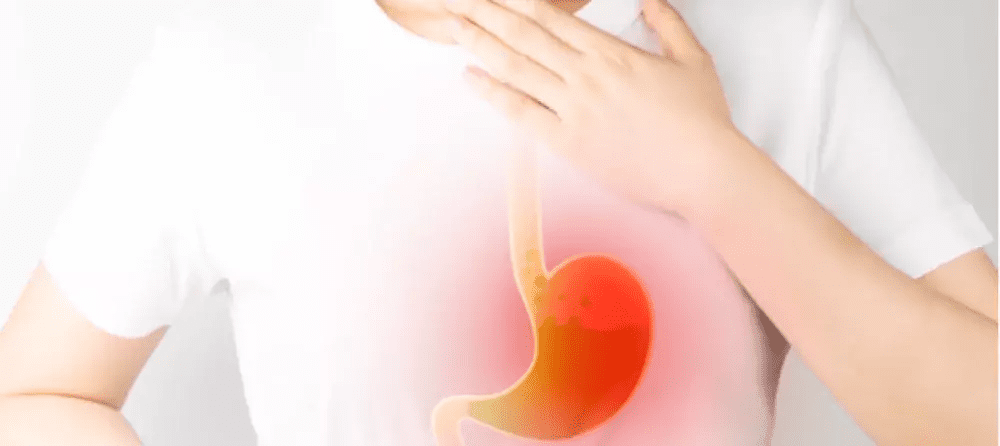 Minh họa cảm giác nóng rát ngực và trào ngược axit từ dạ dày lên thực quản.