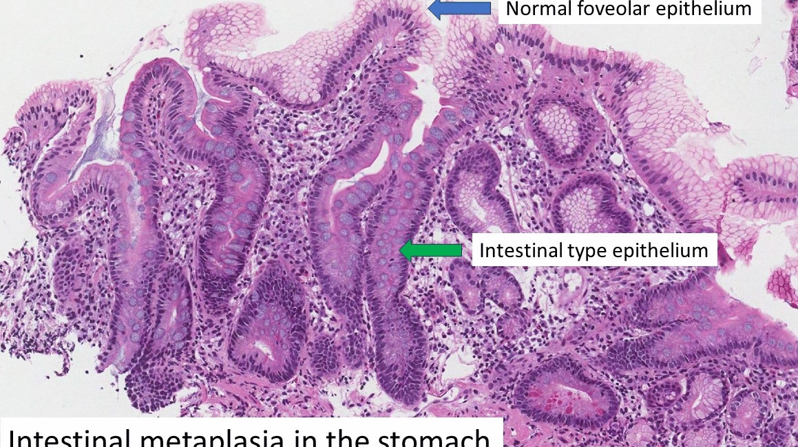Tế bào biểu mô hình ly (goblet cells) đặc trưng của chuyển sản ruột trong niêm mạc dạ dày, nhuộm H&E.