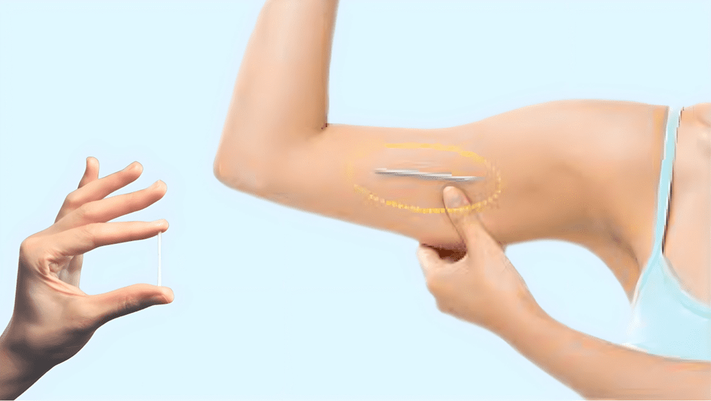 Cấy que tránh thai dưới da cánh tay – phương pháp ngừa thai hiện đại giúp ngừa thai hiệu quả lâu dài.