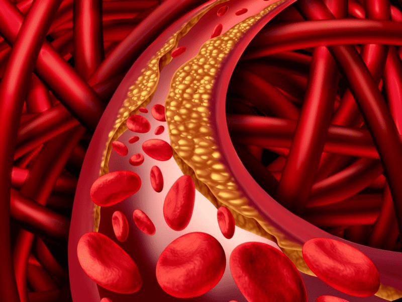 Hình ảnh mỡ máu cao gây xơ vữa động mạch với mảng cholesterol bám trong lòng mạch máu