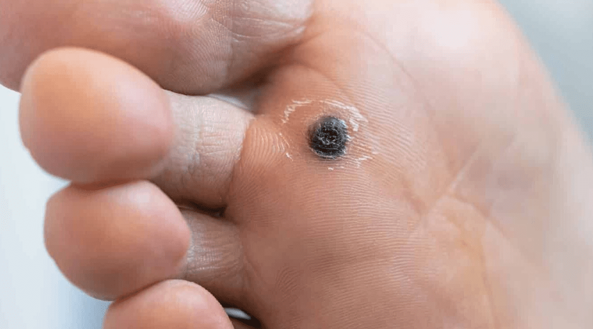 Mụn cóc ở lòng bàn chân với chấm đen đặc trưng do virus HPV gây ra