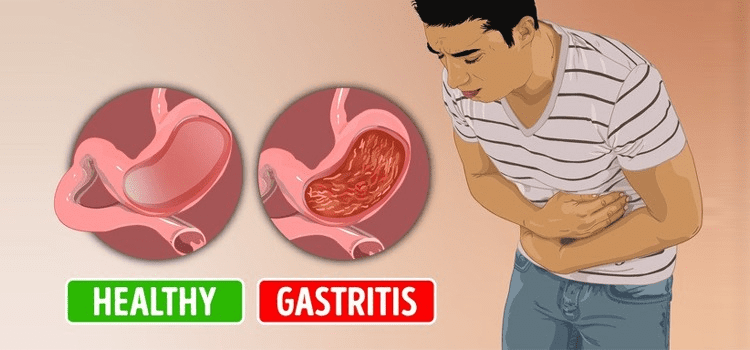 Minh họa viêm dạ dày và dạ dày khỏe mạnh với niêm mạc bị viêm đỏ.