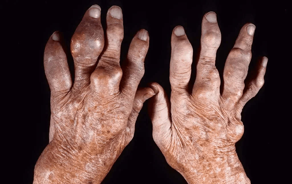 Hình ảnh bàn tay bị biến dạng với hạt tophi lớn do bệnh gout mạn tính
