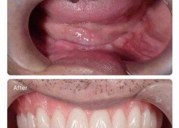CẤY IMPLANT TẠI TIMEC – GIẢI PHÁP PHỤC HỒI RĂNG MẤT HIỆU QUẢ