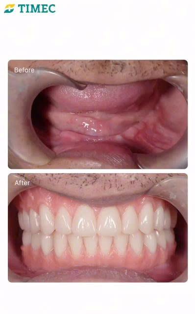 Video cấy ghép Implant phục hồi răng mất tại Timec