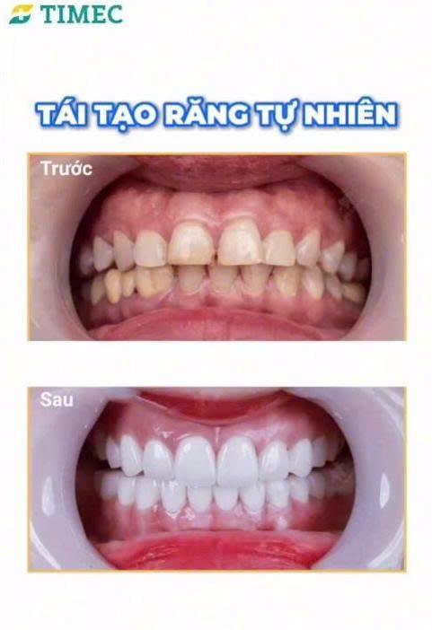 Làm răng sứ thẩm mỹ tại Timec giúp cải thiện nụ cười tự nhiên và hài hòa