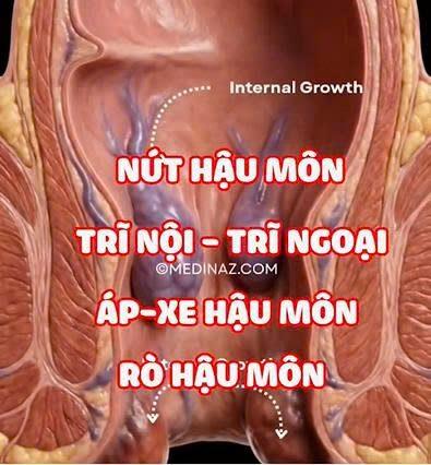 Hình minh họa bệnh trĩ với các búi trĩ ở vùng hậu môn, giúp nhận biết dấu hiệu sớm của bệnh lý hậu môn trực tràng.