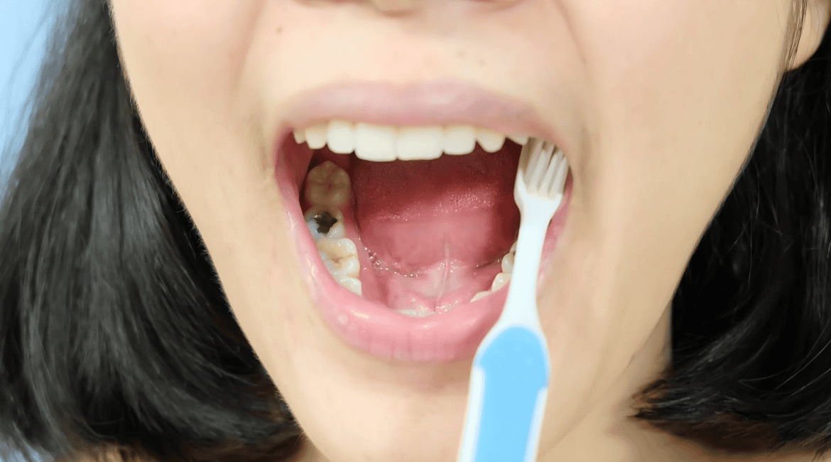 Hình ảnh sâu răng ở răng hàm với lỗ sâu màu nâu đen